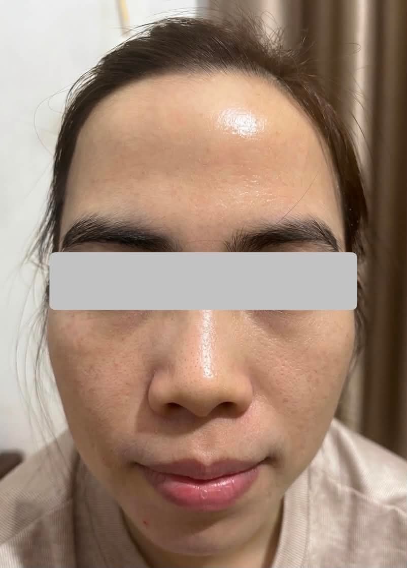 Sau - 1 buổi trẻ hoá không xâm lấn