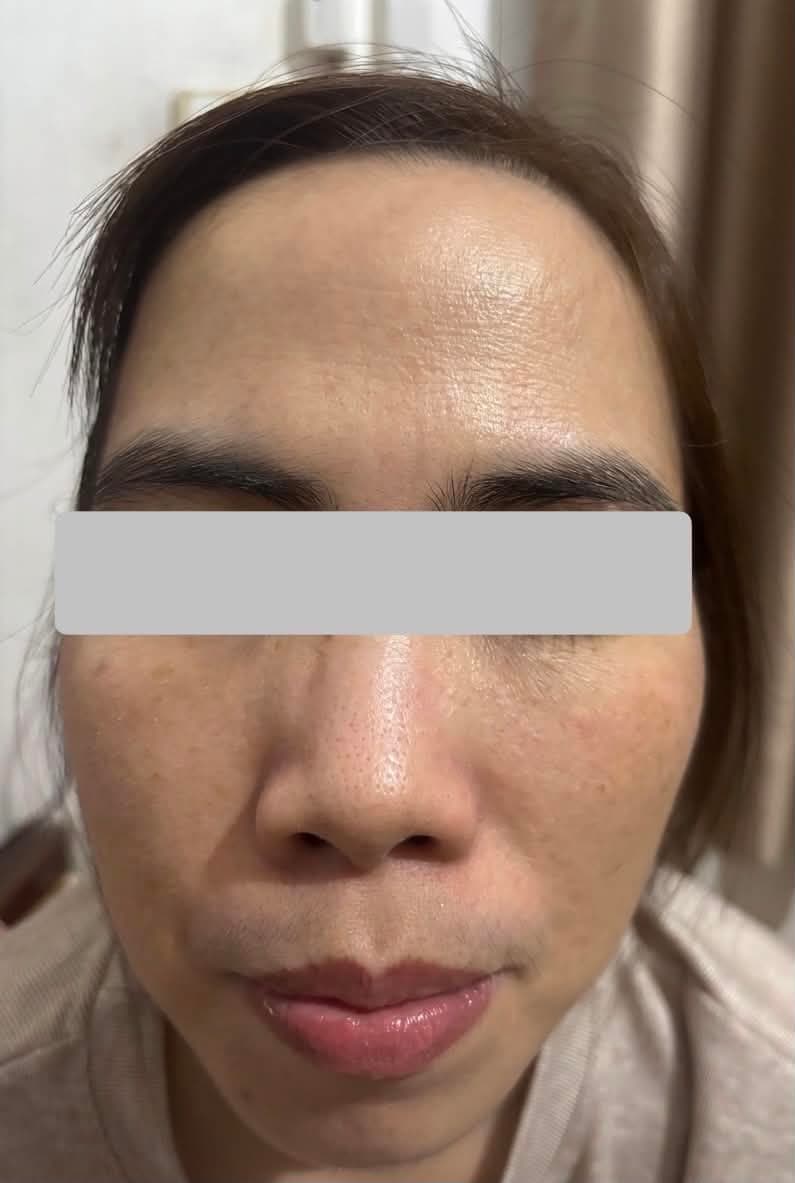 Trước - 1 buổi trẻ hoá không xâm lấn