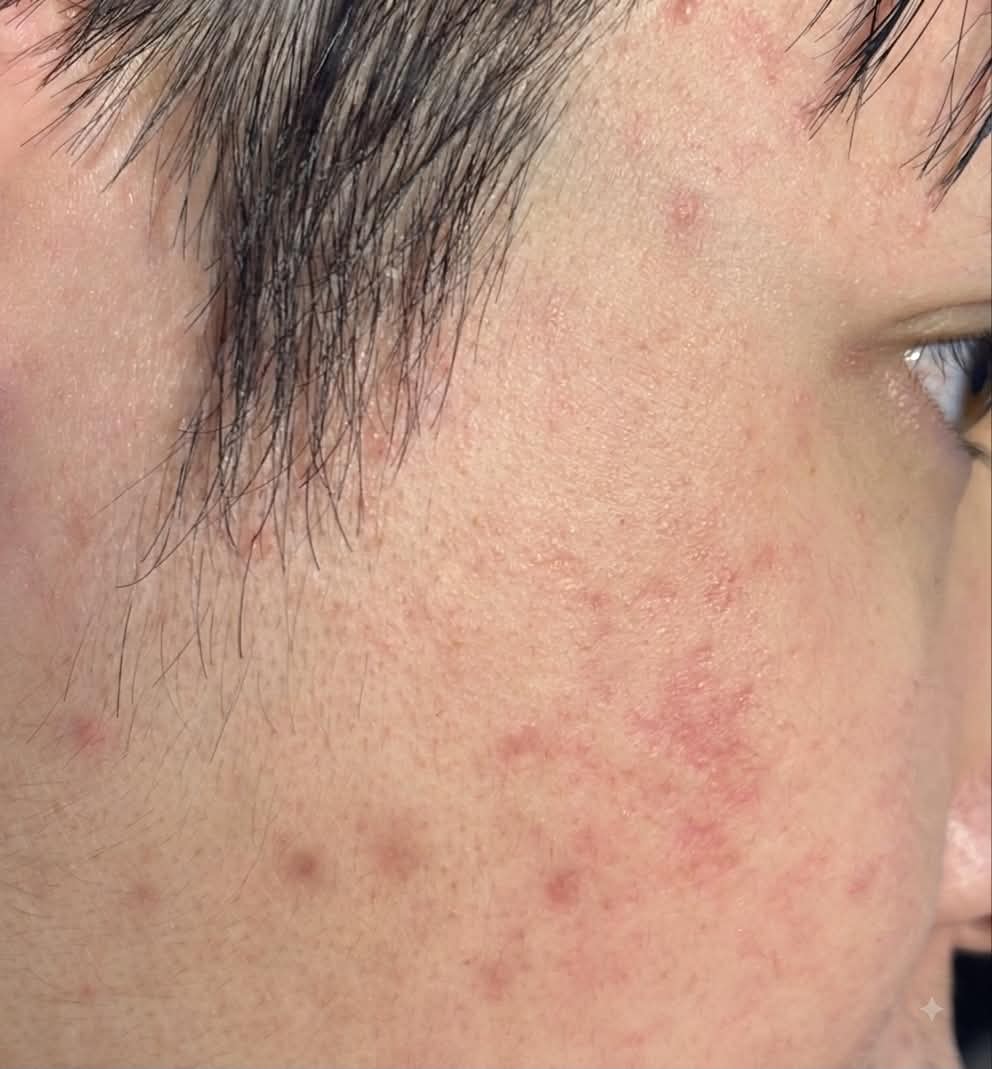 Sau - Kiểm soát mụn tốt giúp hạn chế sẹo