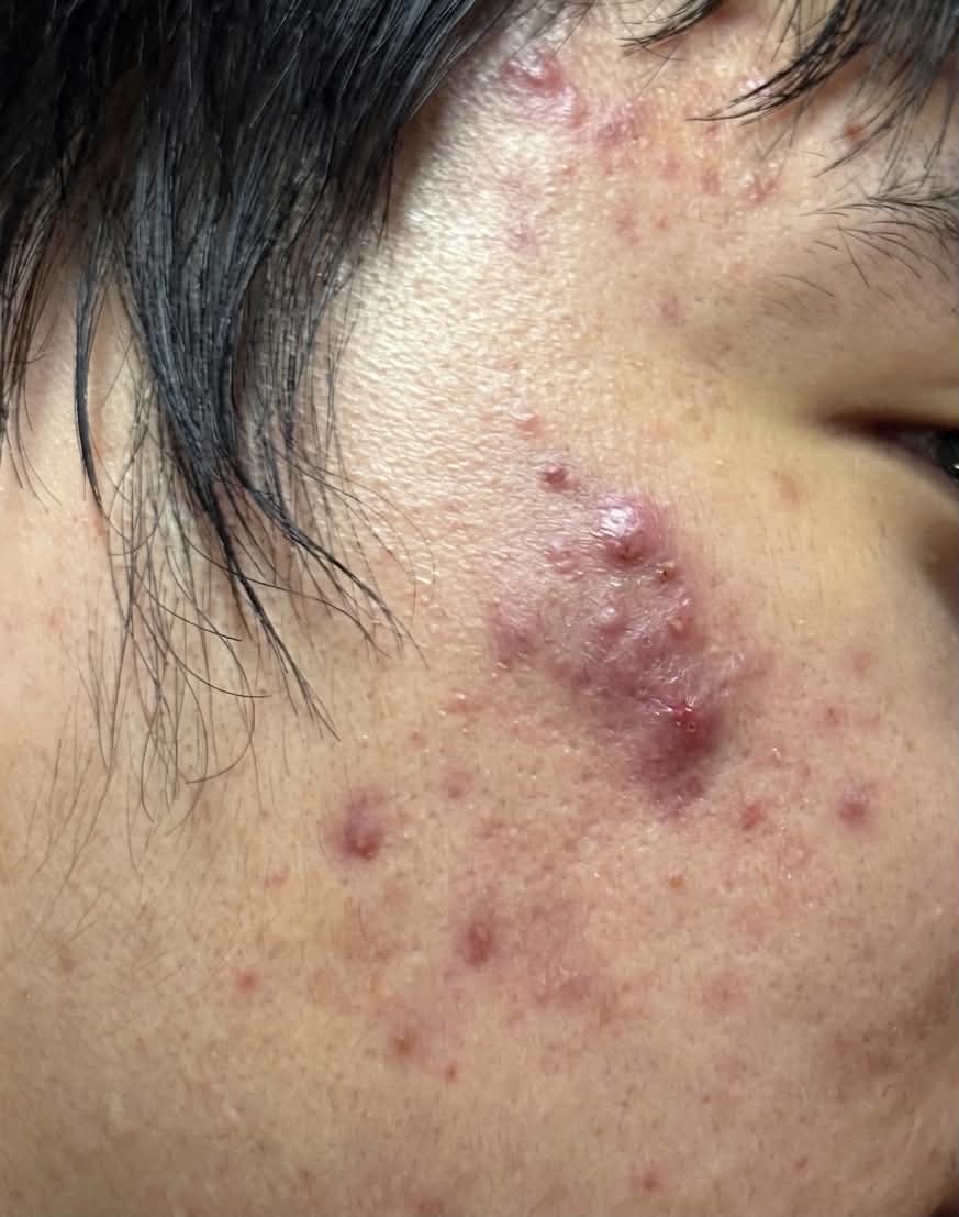Trước - Kiểm soát mụn tốt giúp hạn chế sẹo