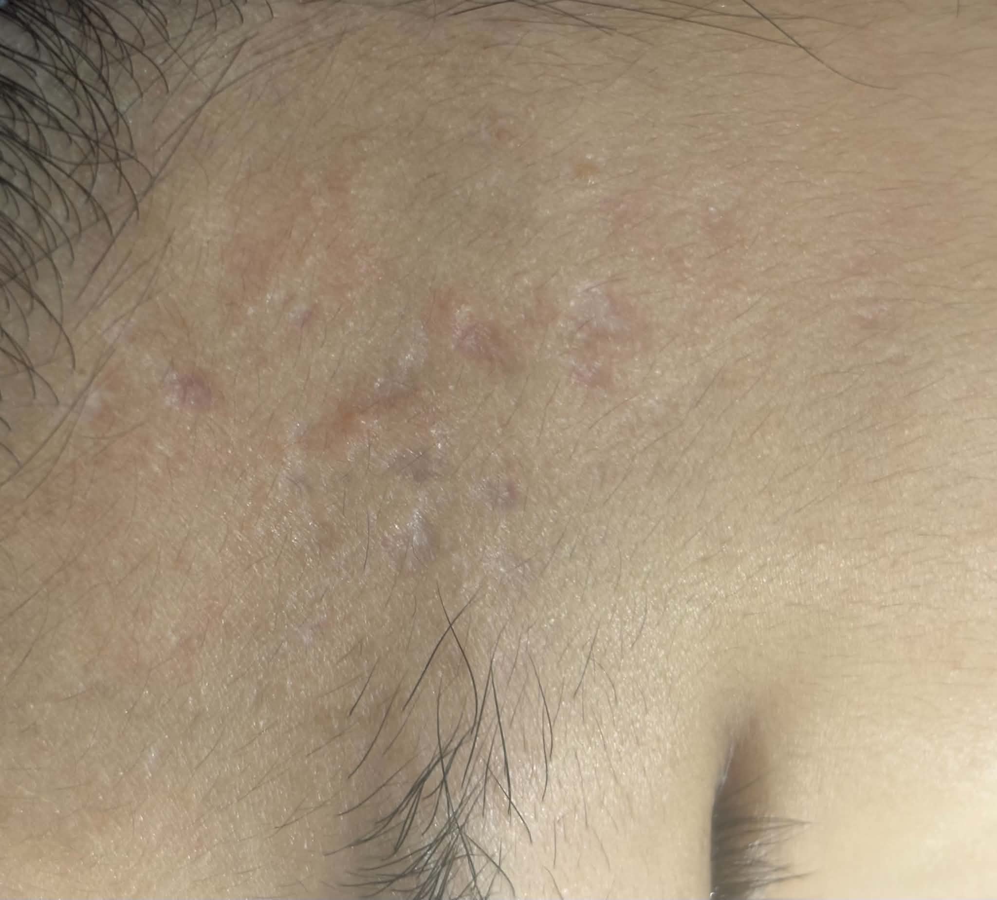 Sau - Phục hồi da do sẹo