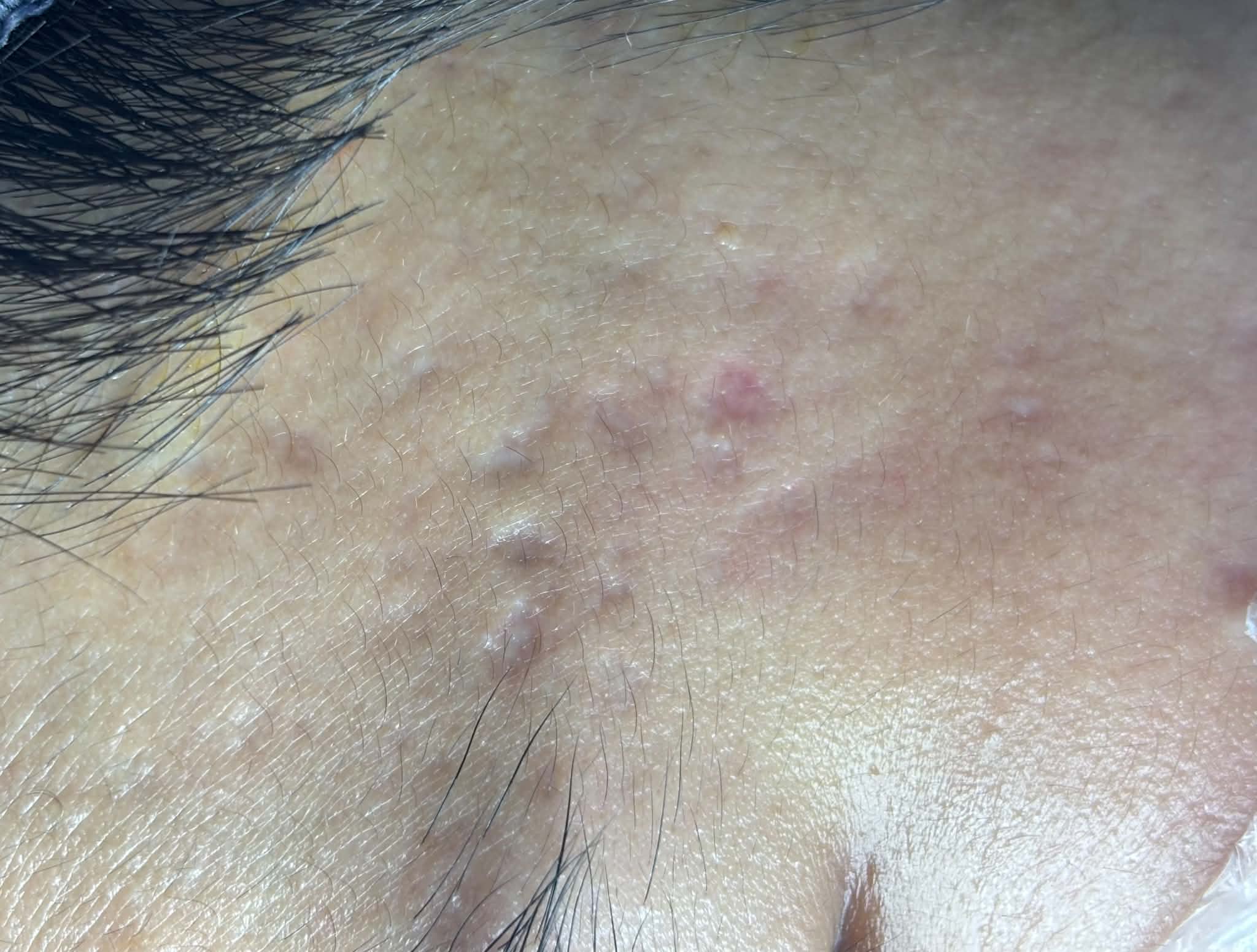Trước - Phục hồi da do sẹo